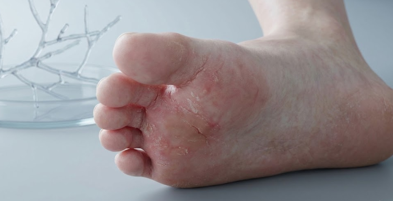 Athlete's Foot Risk